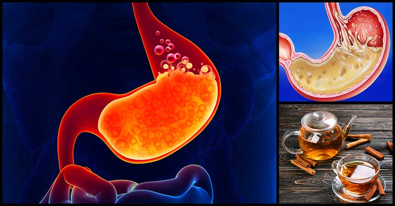 Natural Home Remedies for Acidity: Fast Relief Tips
