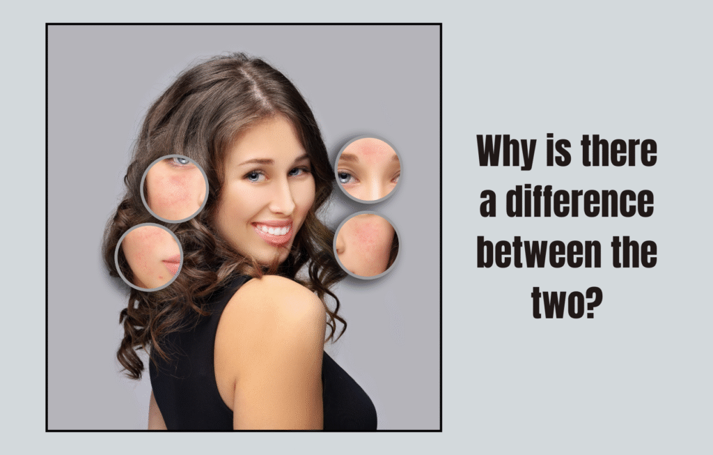 Hormonal Acne vs Regular Acne: How to Spot and Treat Them Differently