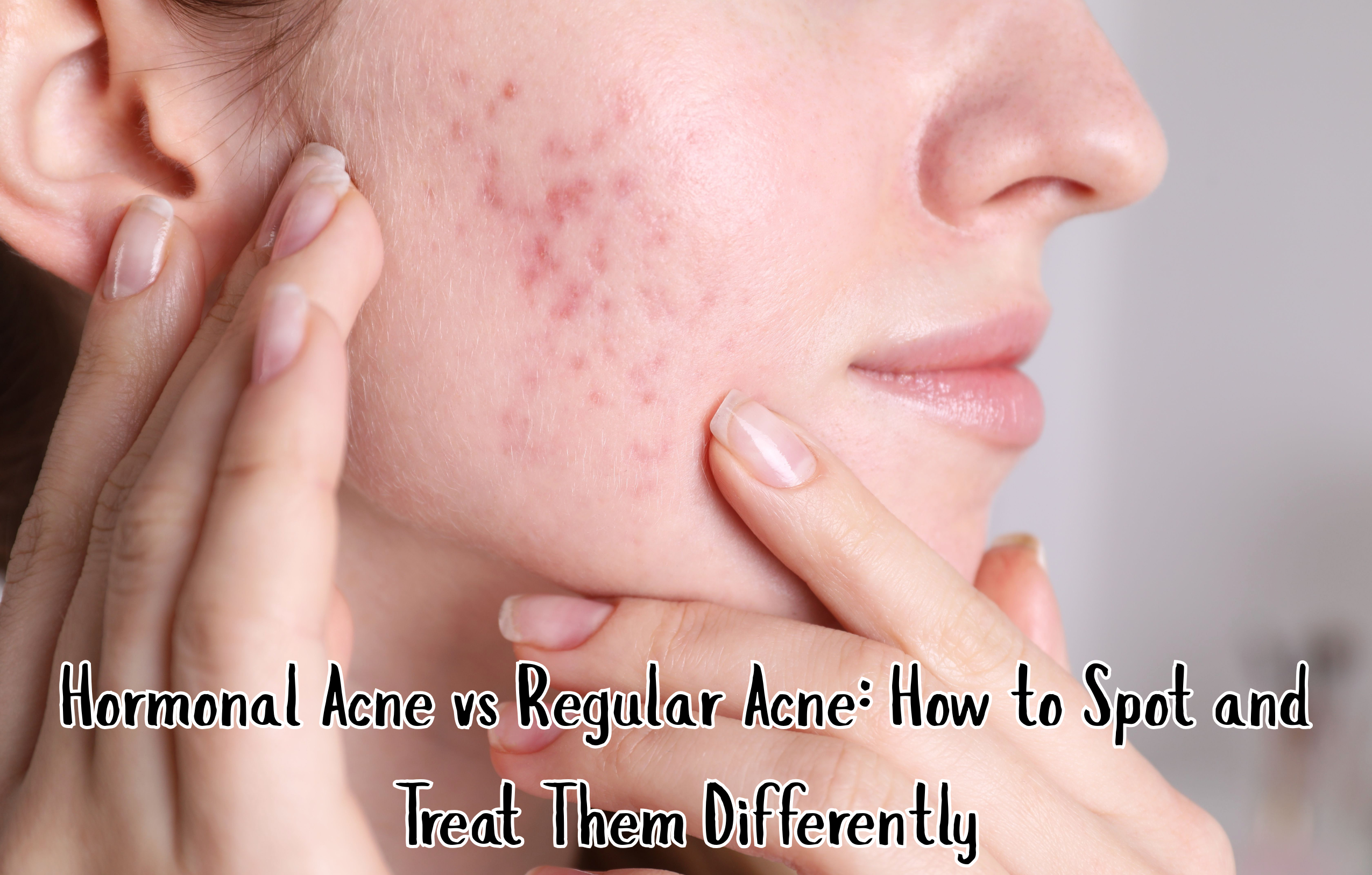 Hormonal Acne vs Regular Acne: How to Spot and Treat Them Differently