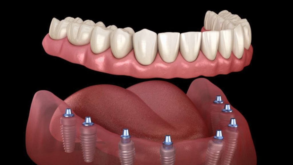 Affordable Dental Implants in the USA: Cost, Process, and Insurance Coverage