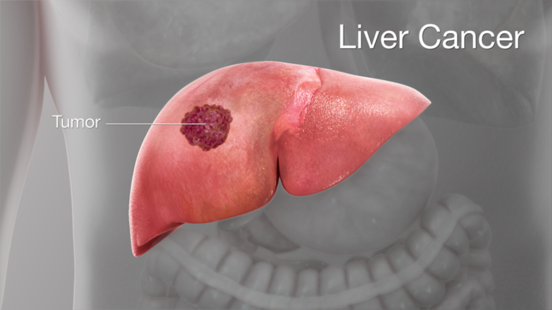 Liver Cancer Symptoms Explained: Recognize the Warning Signs Early