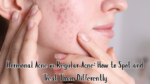 Hormonal Acne vs Regular Acne: How to Spot and Treat Them Differently