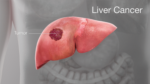 Liver Cancer Symptoms Explained: Recognize the Warning Signs Early