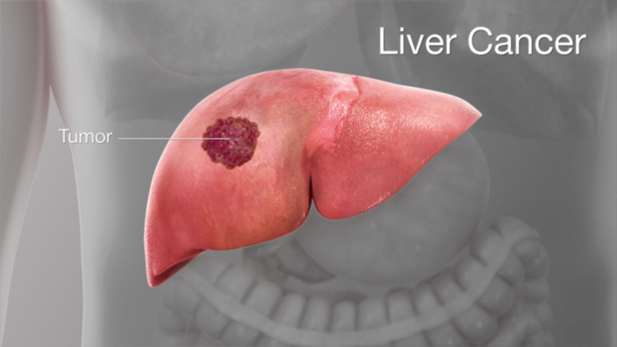 Liver Cancer Symptoms Explained: Recognize the Warning Signs Early